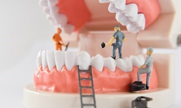 Indirect restorations - preparation and placements